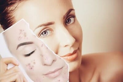 Dermapen- Everything You Need to Know About Micro-Needling